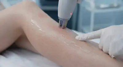 Epilare Laser